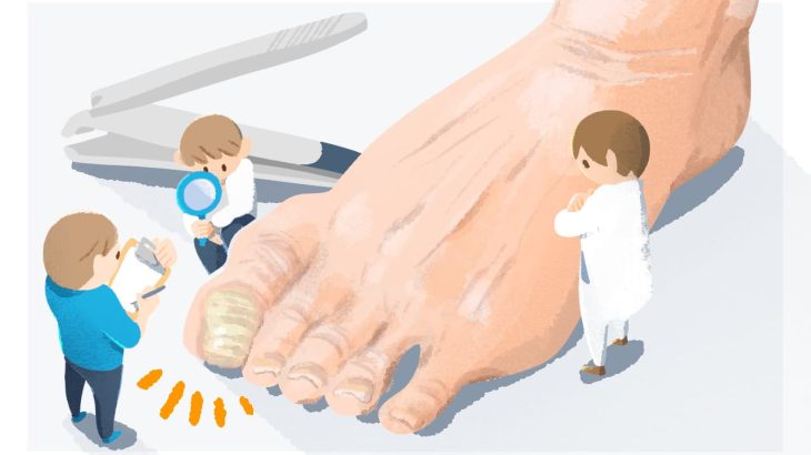高齢者の足の爪には色々とトラブルがある？原因と特徴、予防法について解説